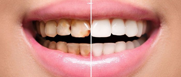 Dental Restoration & Restorative Dentistry in Murfreesboro, TN Dental Restoration & Restorative Dentistry in Murfreesboro, TN