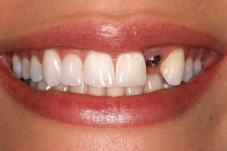 PROSTHODONTICS & IMPLANTOLOGY _ Sowmya Multi Speciality Dental Clinic