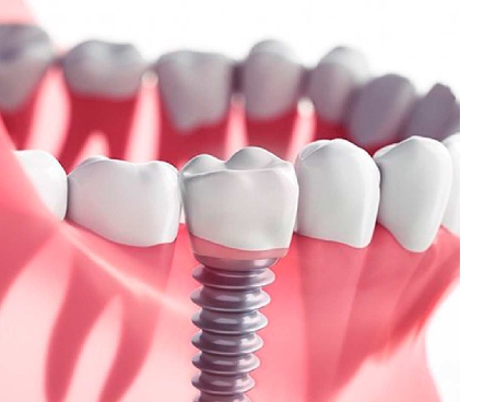 implants ایمپلنت دندان