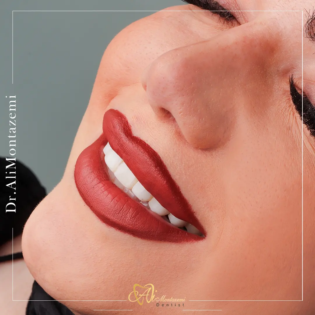 اصلاح طرح لبخند